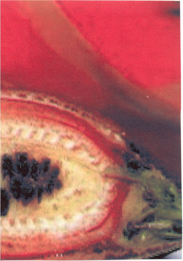 Ovary - 
