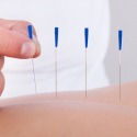 Acupuncture therapy  by Body Med