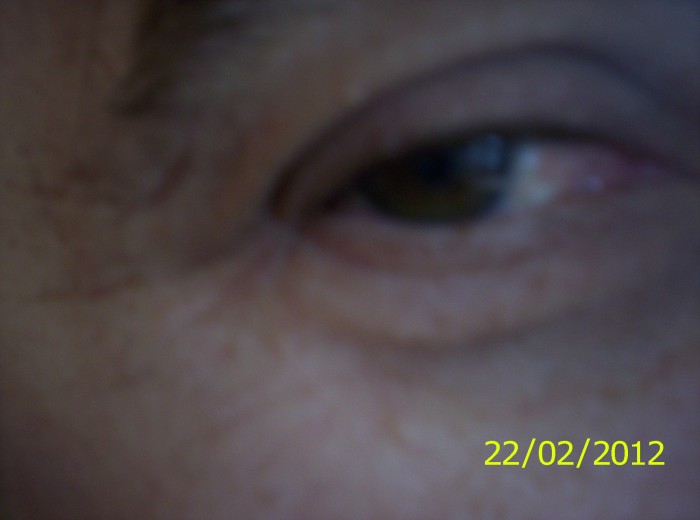 Not Sleepy But Poorly Eye - 